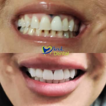 Slider image (9) Kool Dental